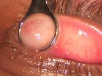 Verwijderen van een chalazion middels curettage