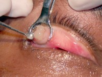 Verwijderen van een chalazion middels curettage