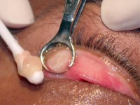 Verwijderen van een chalazion middels curettage