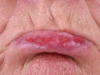 Cheilitis actinica