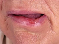 Cheilitis actinica