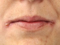 Cheilitis angularis (Perleche)