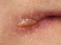 Cheilitis angularis (Perleche)