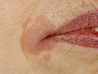 Cheilitis angularis (Perleche)