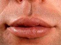 Cheilitis granulomatosa