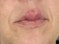 Cheilitis granulomatosa