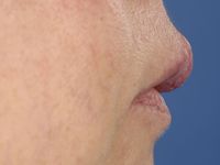 Cheilitis granulomatosa