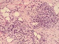 Cheilitis granulomatosa