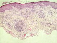 Cheilitis granulomatosa