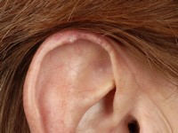 Chondrodermatitis nodularis helicis