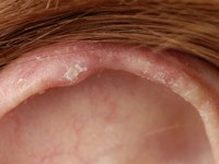 Chondrodermatitis nodularis helicis