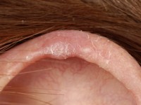 Chondrodermatitis nodularis helicis