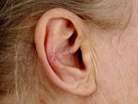 Chondrodermatitis nodularis helicis