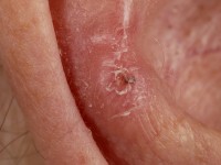 Chondrodermatitis nodularis helicis