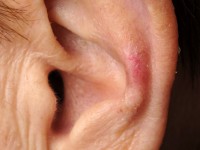 Chondrodermatitis nodularis helicis