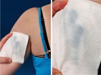 Chromhidrosis, verkleurd zweet