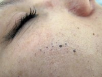 Chromhidrosis, verkleurd zweet