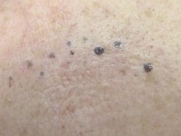 Chromhidrosis, verkleurd zweet