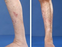 Chronische graft versus host disease