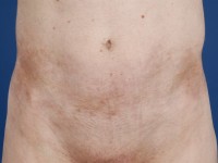 Chronische graft versus host disease