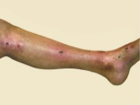 Chronische graft versus host disease