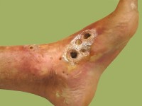 Chronische graft versus host disease