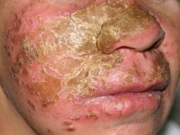 Chronische mucocutane candidiasis