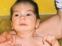 Cold-induced sweating syndrome