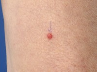 Clear cell acanthoma