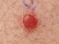 Clear cell acanthoma