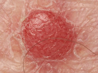 Clear cell acanthoma