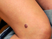 Clear cell acanthoma