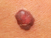 Clear cell acanthoma