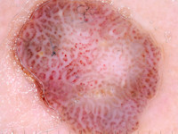 Clear cell acanthoma