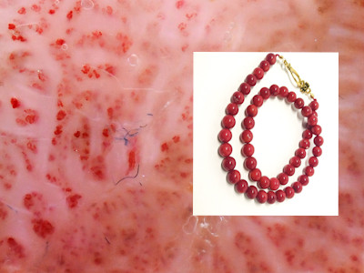 Clear cell acanthoma