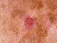 Clear cell atypical fibroxanthoma