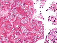 Coccidioidomycosis