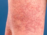 Cutaneous collagenous vasculopathy