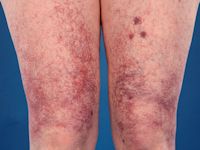 Cutaneous collagenous vasculopathy