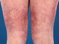 Cutaneous collagenous vasculopathy