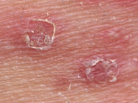 Collerette bij Candida (eilandjes voor de kust)