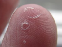 Collerette als rest van vesikel bij atopisch eczeem