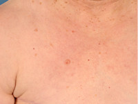 Composite hemangioendothelioma