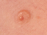 Composite hemangioendothelioma