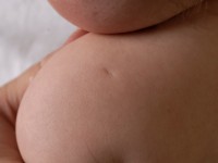 Acromial dimple