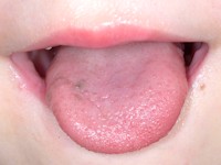 Orale melanosis (melanotic macule)