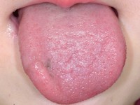 Orale melanosis (melanotic macule)