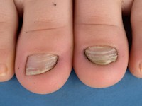 Congenital malalignment of the great toenail