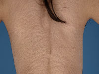 Congenitale hypertrichosis
