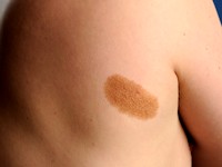Congenitale melanocytaire naevus